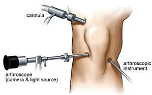 Meniscus-scheur-operatie