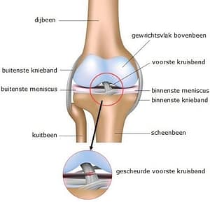 Voorste kruisband letsel