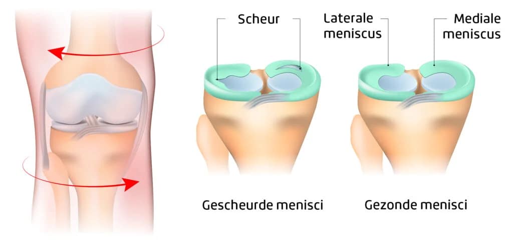 Meniscus letsel
