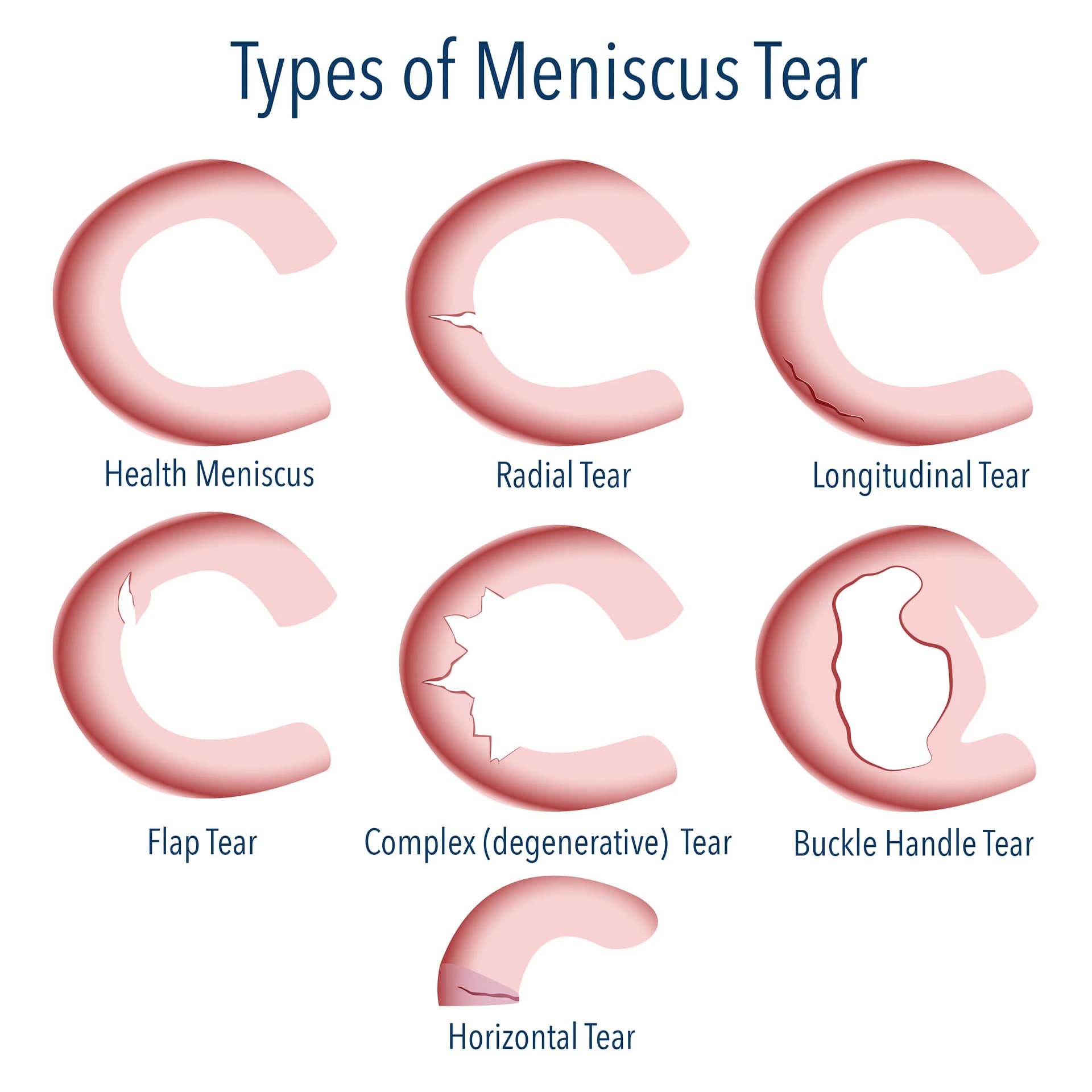 Meniscus scheur