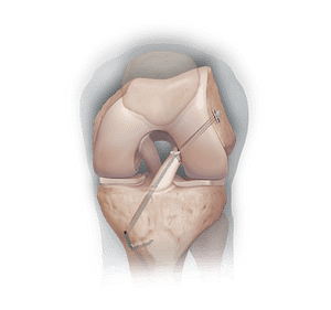 knie-VKB-reconstructie
